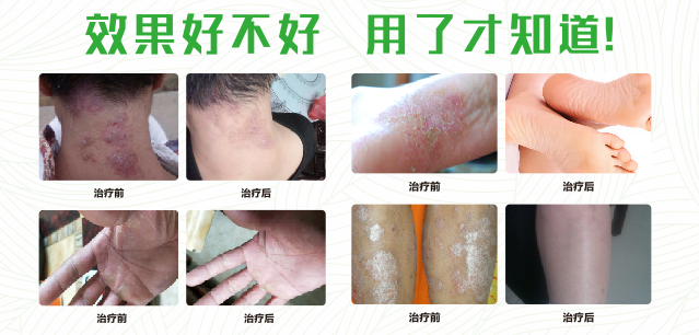 樱桃视频APP免费下载真菌清噴劑 樱桃视频APP免费下载真菌清噴劑